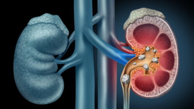 kidney stones
